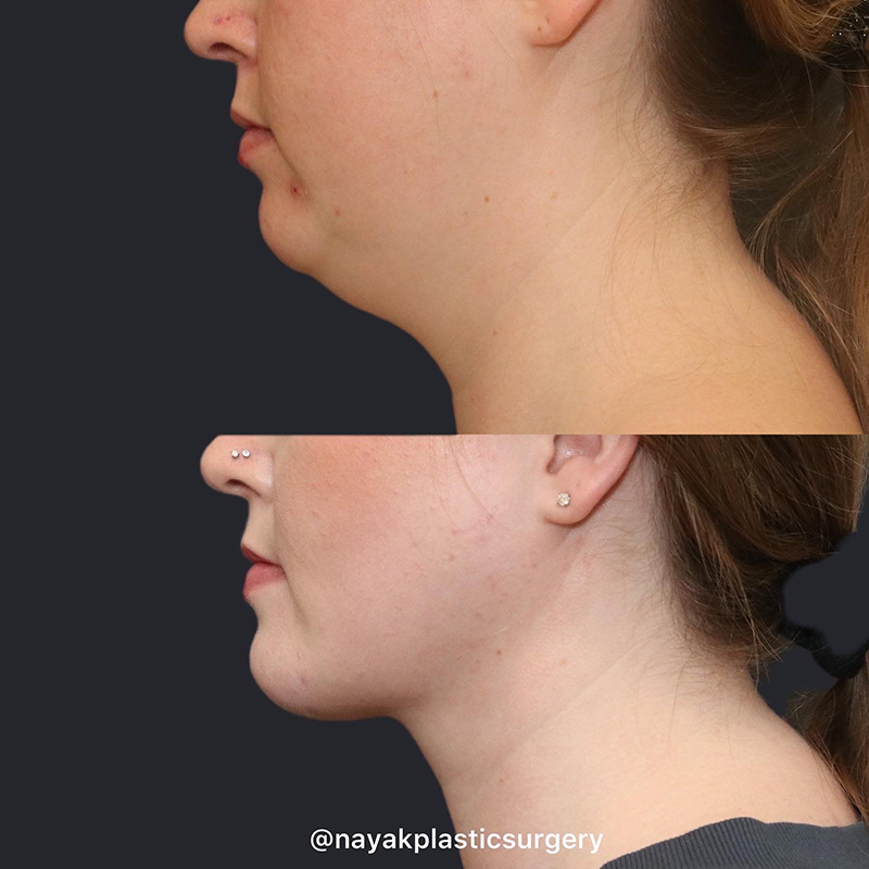 Buccal Fat Removal Before & After Image