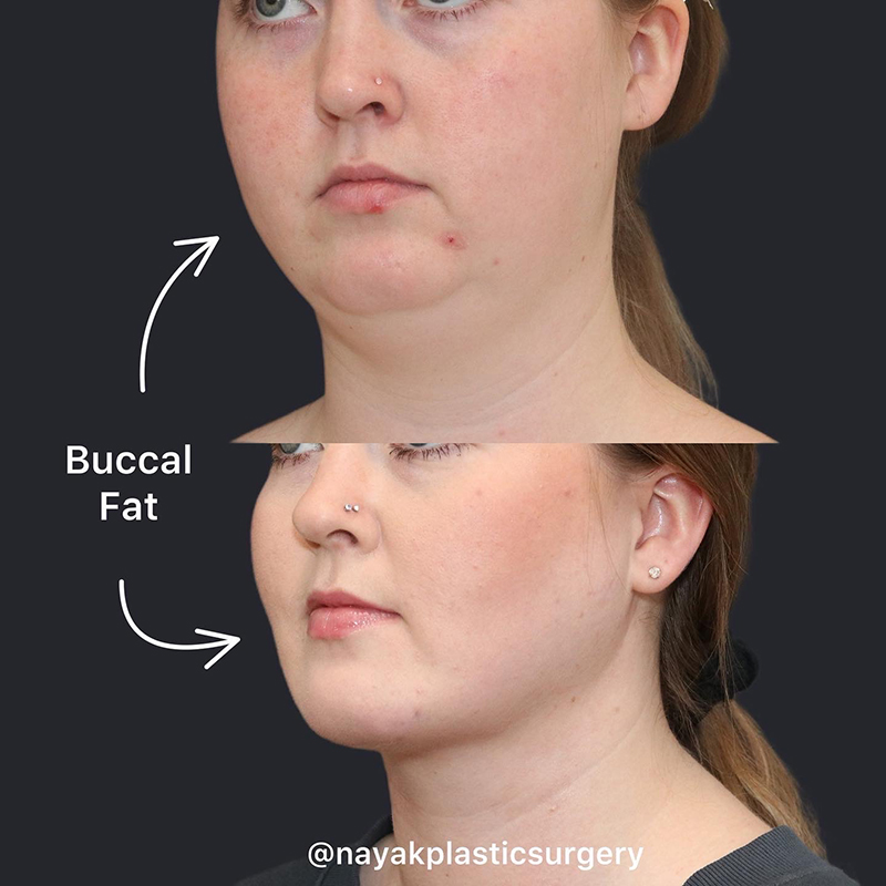 Buccal Fat Removal Before & After Image