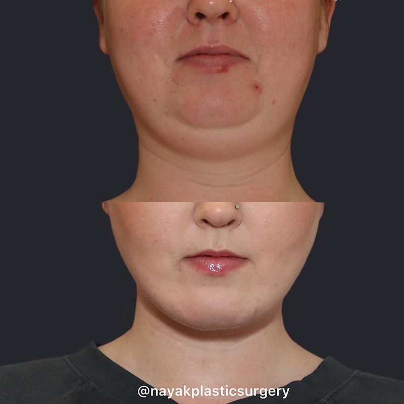 Buccal Fat Removal Before & After Image