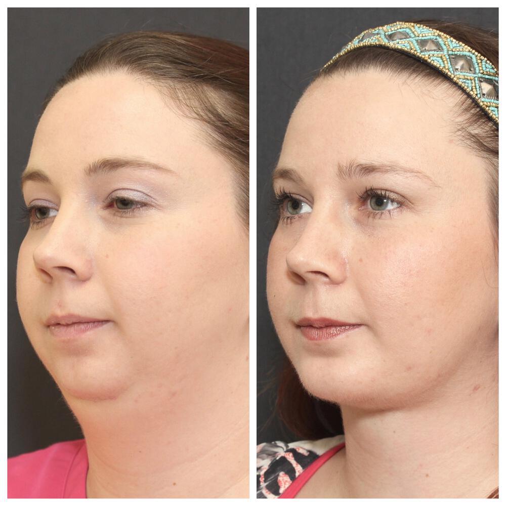 Chin Implants Before & After Image