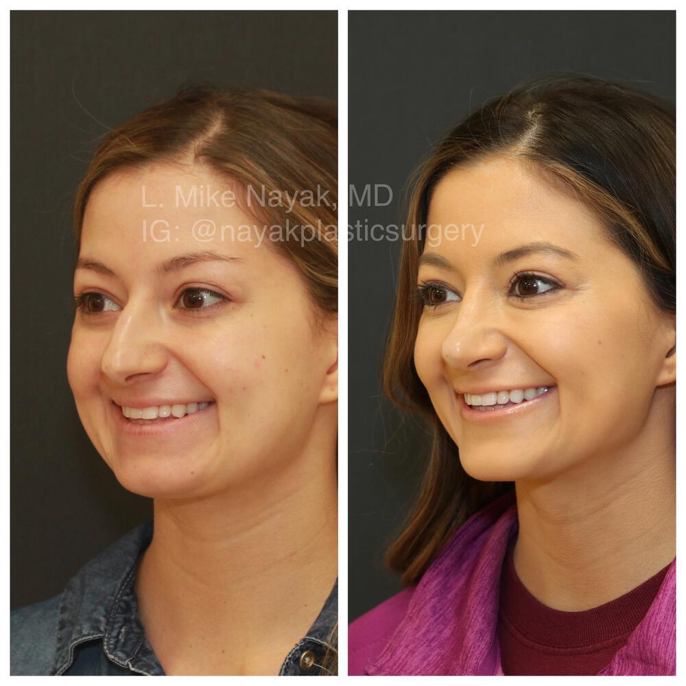 Chin Implants Before & After Image