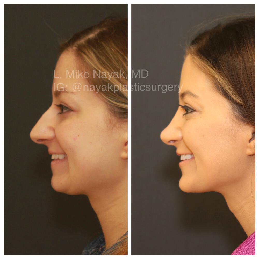 Chin Implants Before & After Image