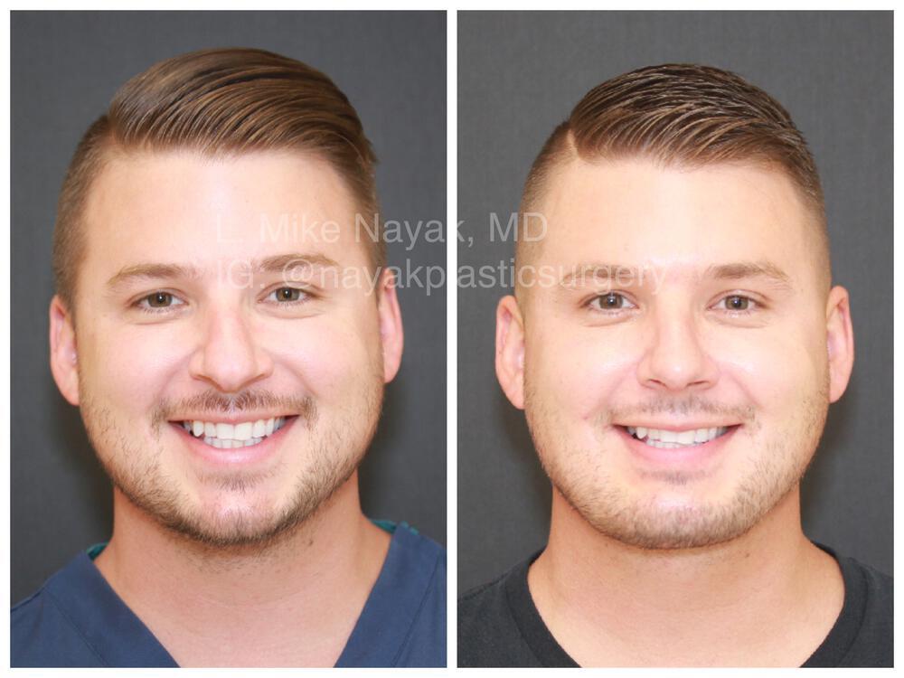 Chin Implants Before & After Image