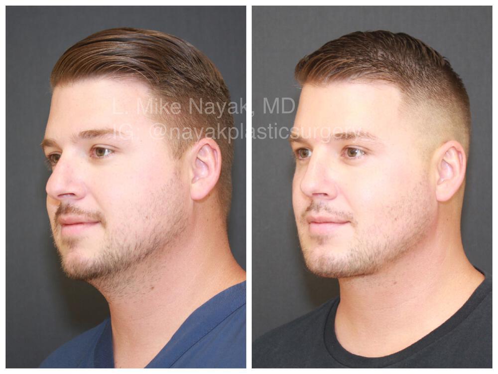 Chin Implants Before & After Image