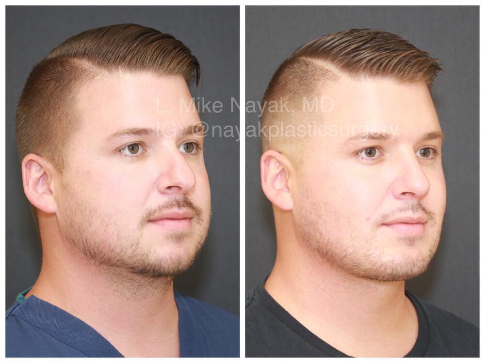 Chin Implants Before & After Image