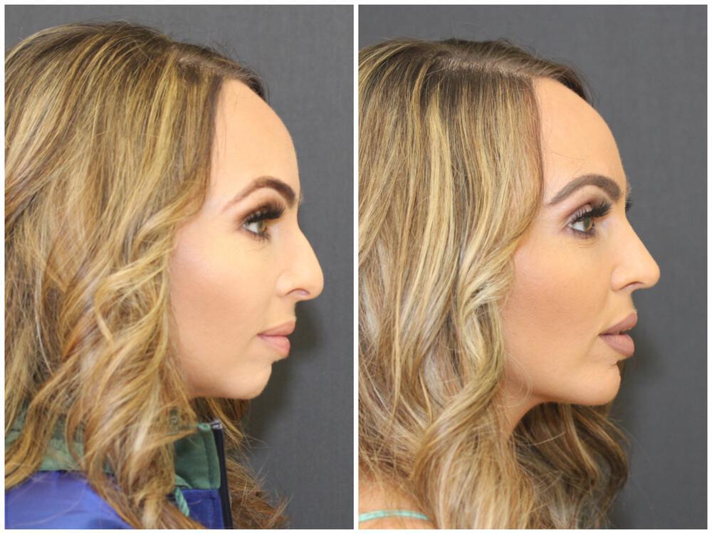 Chin Implants Before & After Image