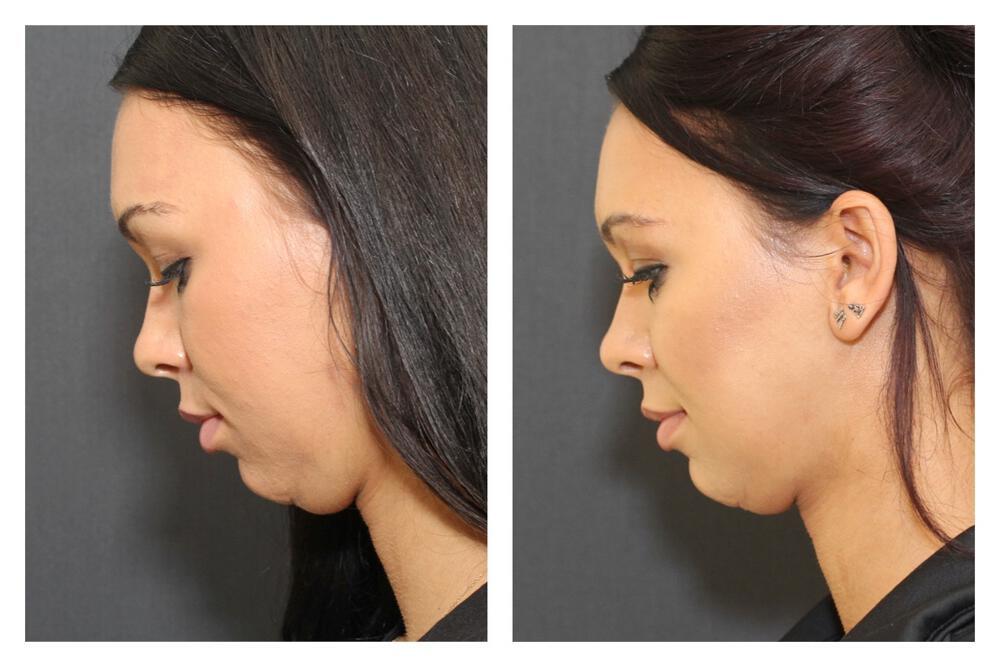 Chin Implants Before & After Image