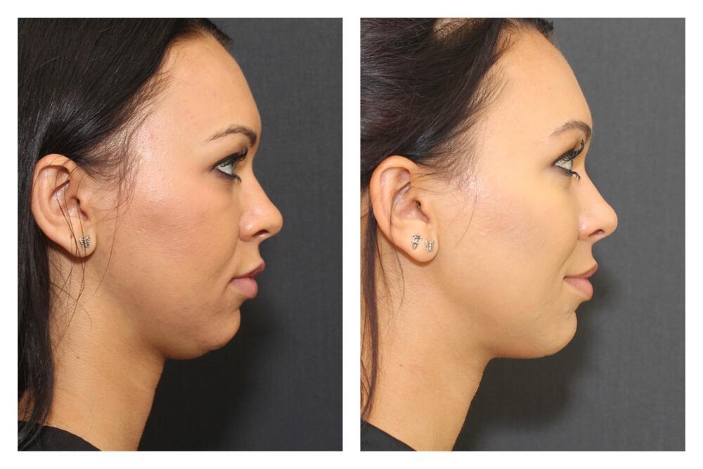 Chin Implants Before & After Image