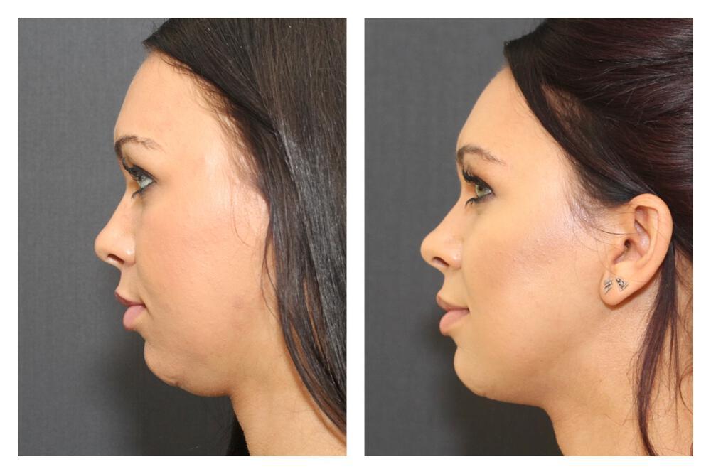 Chin Implants Before & After Image