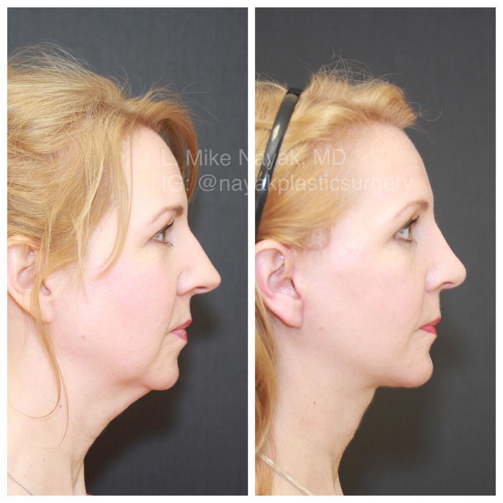 Chin Implants Before & After Image