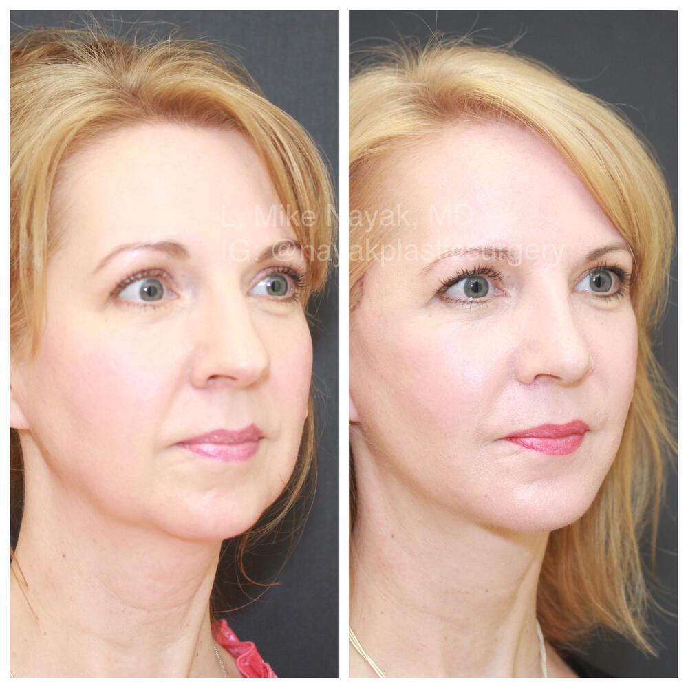 Chin Implants Before & After Image