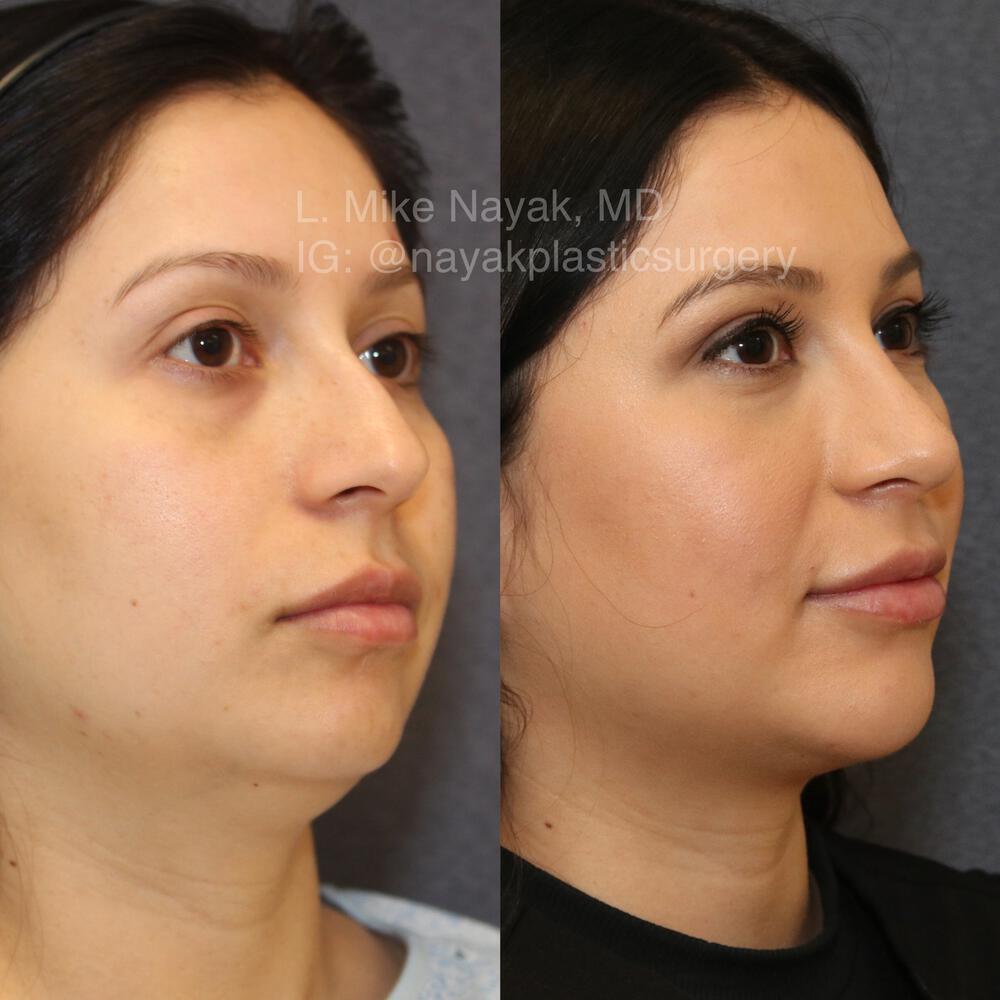 Chin Implants Before & After Image