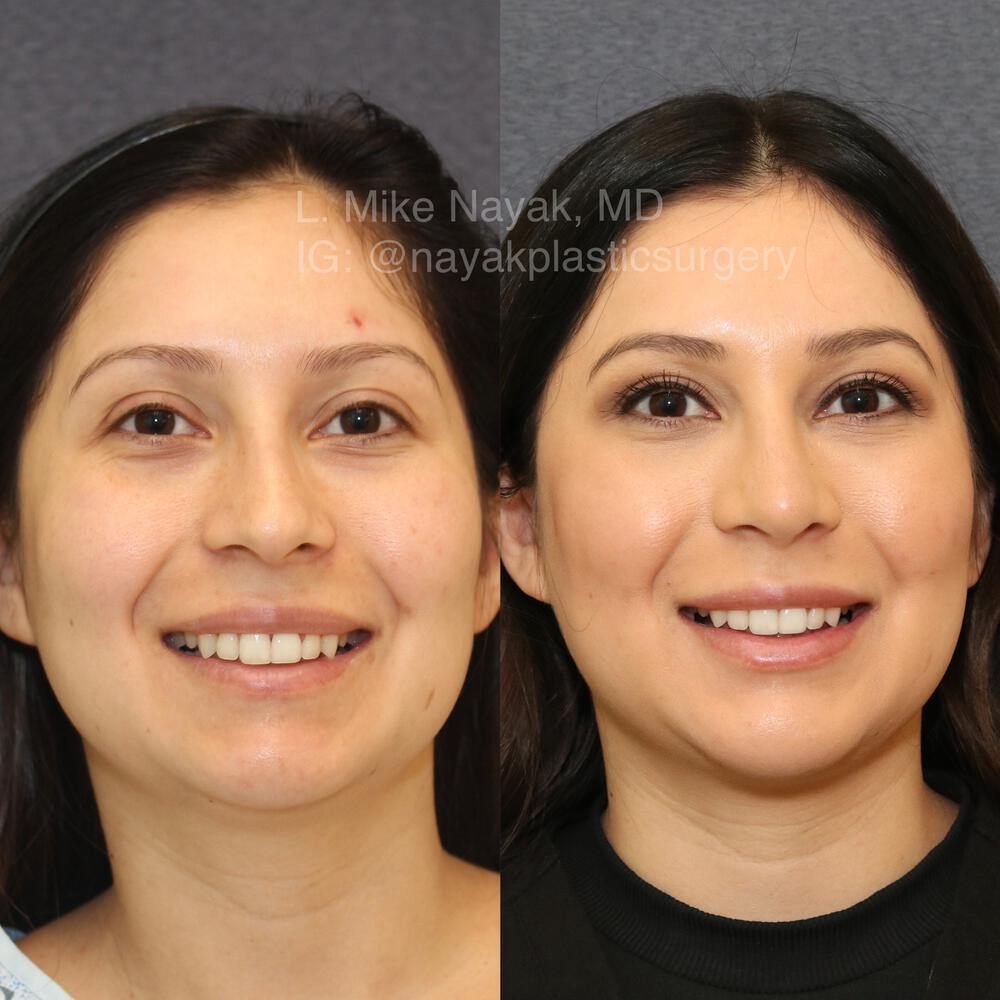 Chin Implants Before & After Image