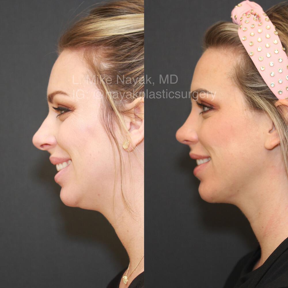 Chin Implants Before & After Image