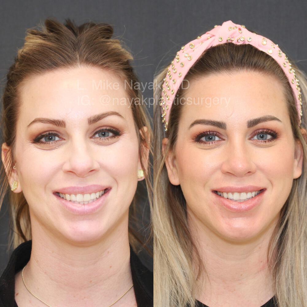 Chin Implants Before & After Image