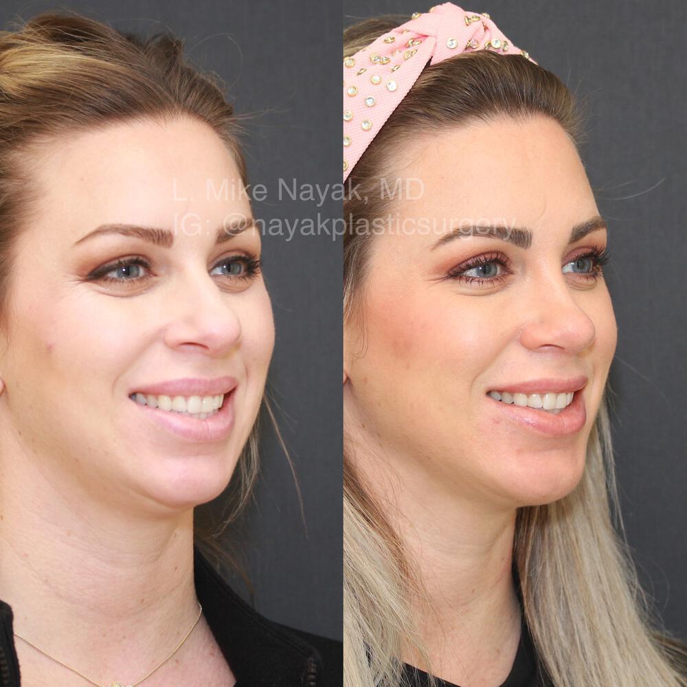 Chin Implants Before & After Image