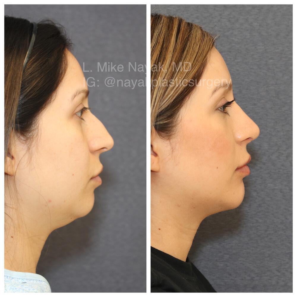 Chin Implants Before & After Image