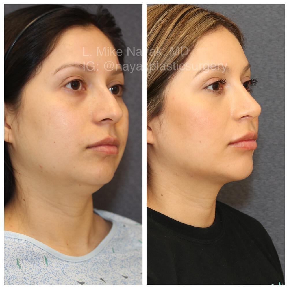 Chin Implants Before & After Image