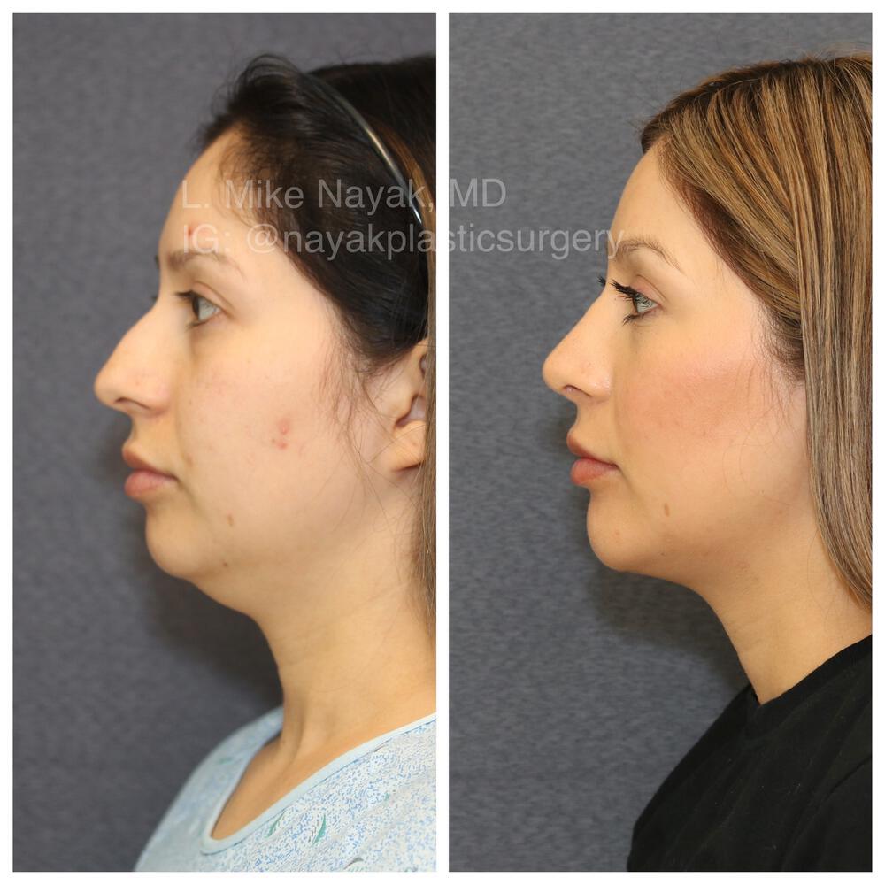 Chin Implants Before & After Image