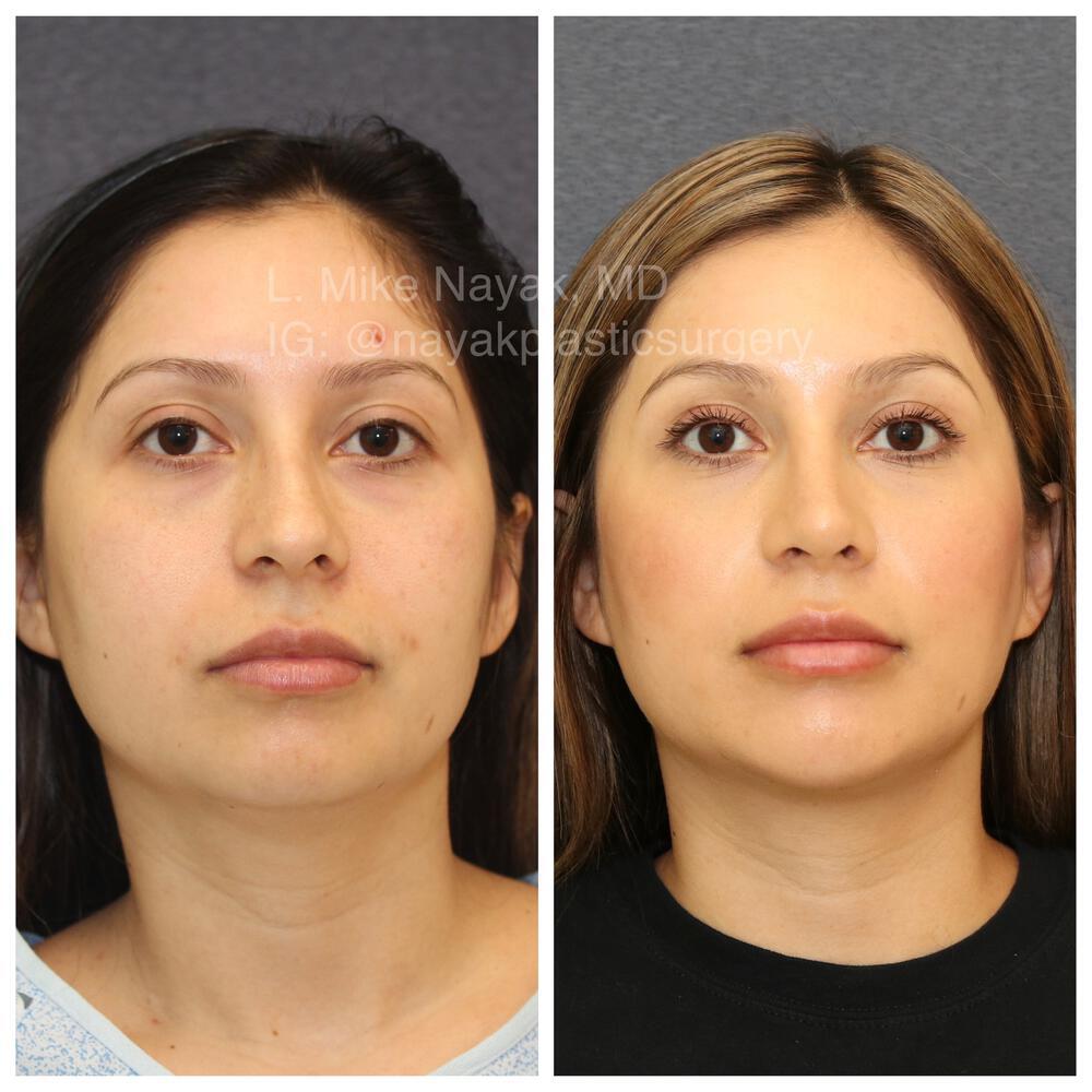 Chin Implants Before & After Image