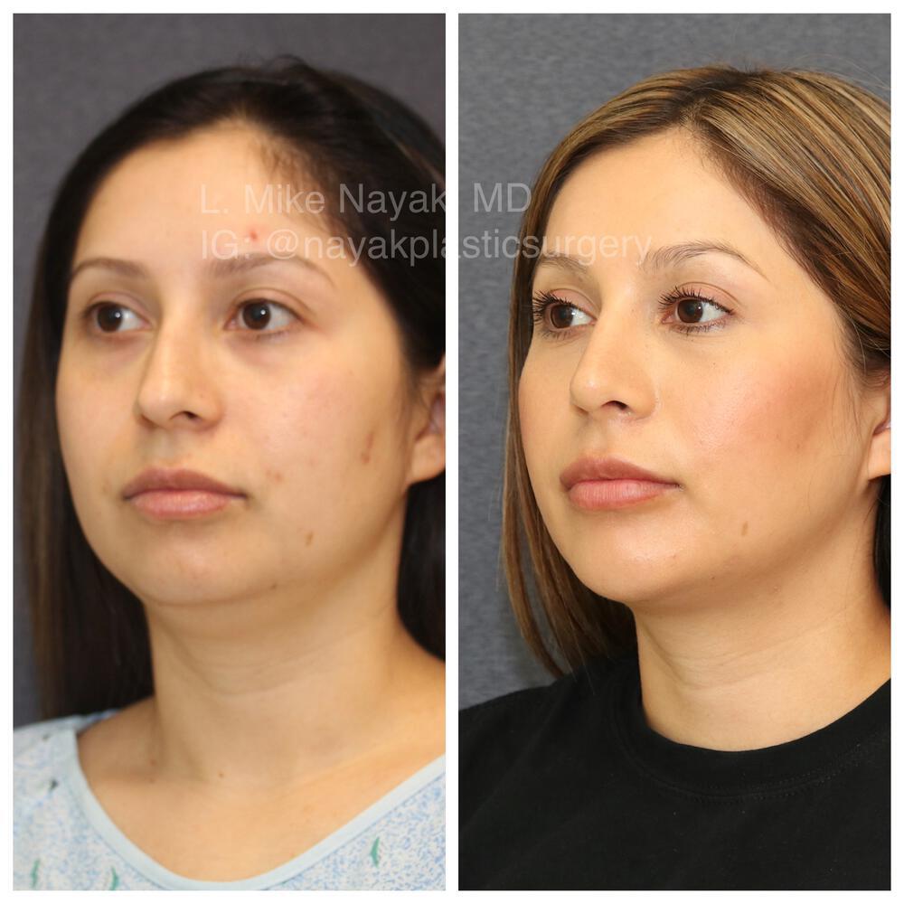 Chin Implants Before & After Image