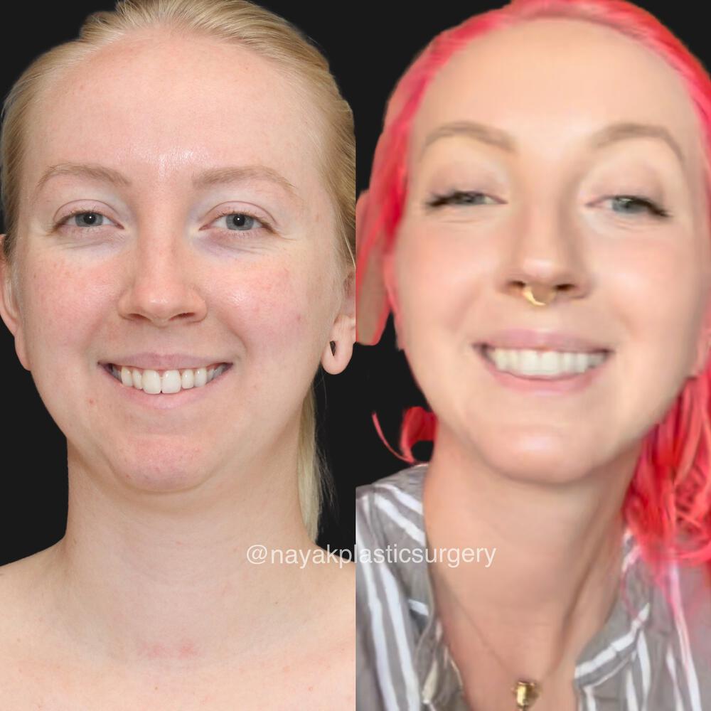 Chin Implants Before & After Image