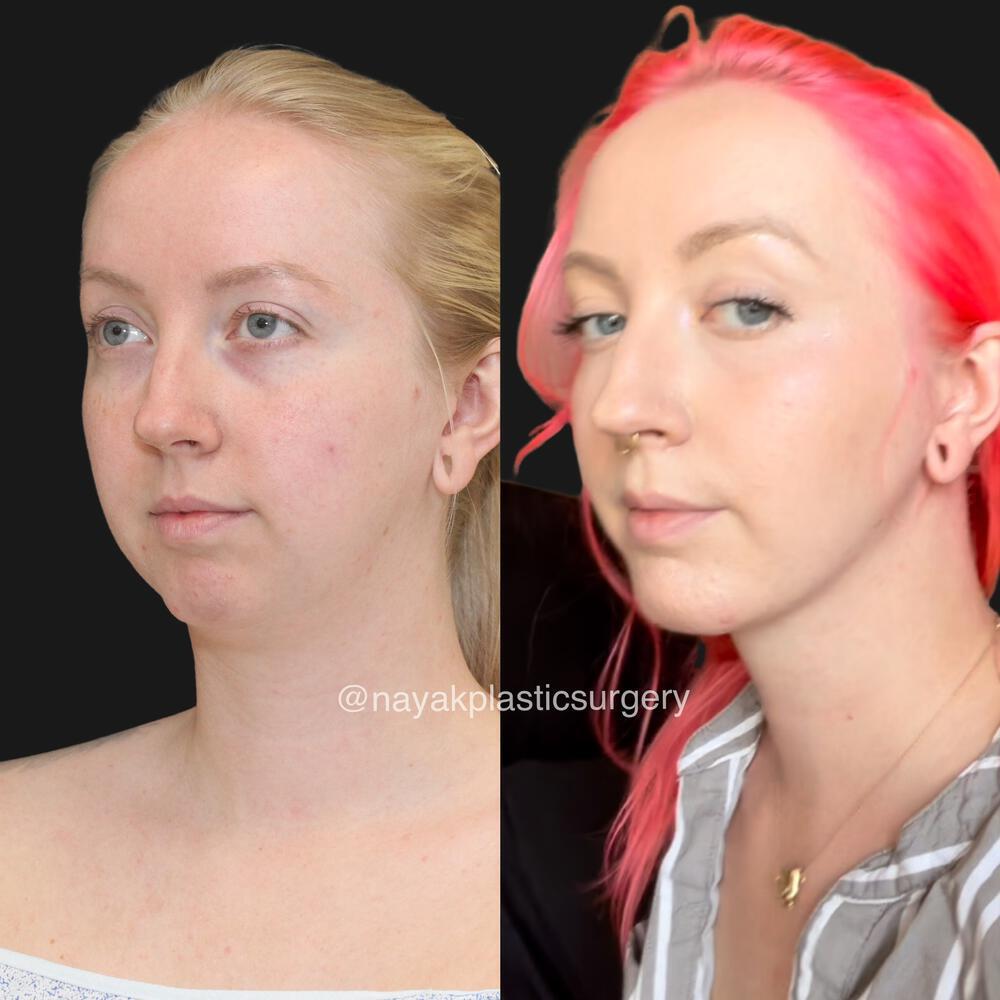 Chin Implants Before & After Image