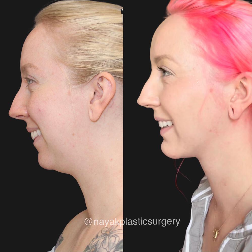 Chin Implants Before & After Image