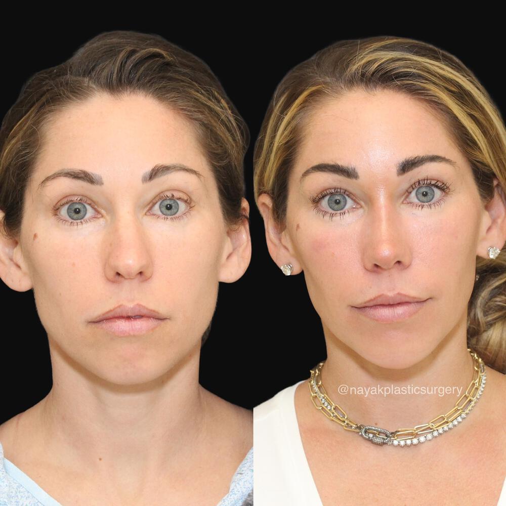 Chin Implants Before & After Image