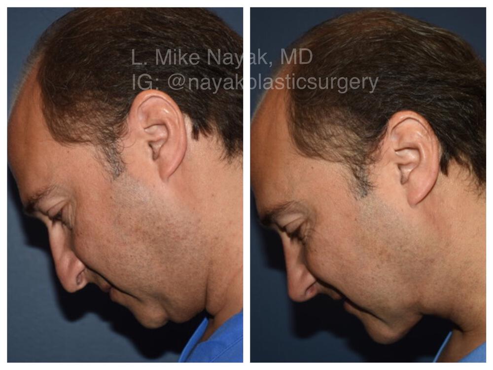 Chin Implants Before & After Image