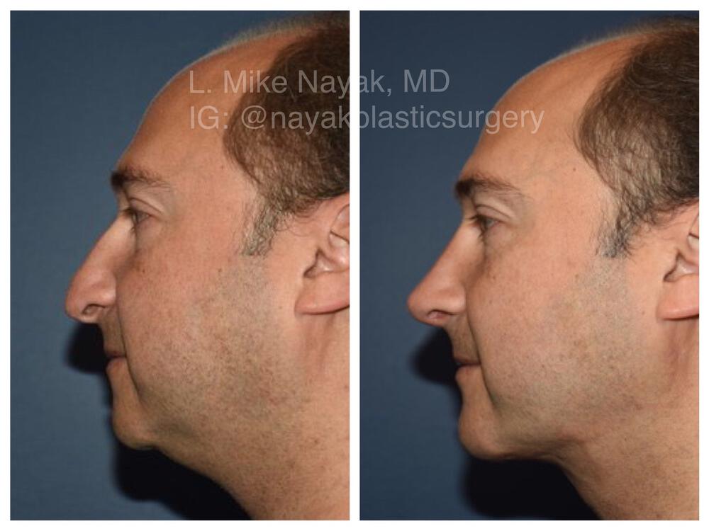 Chin Implants Before & After Image