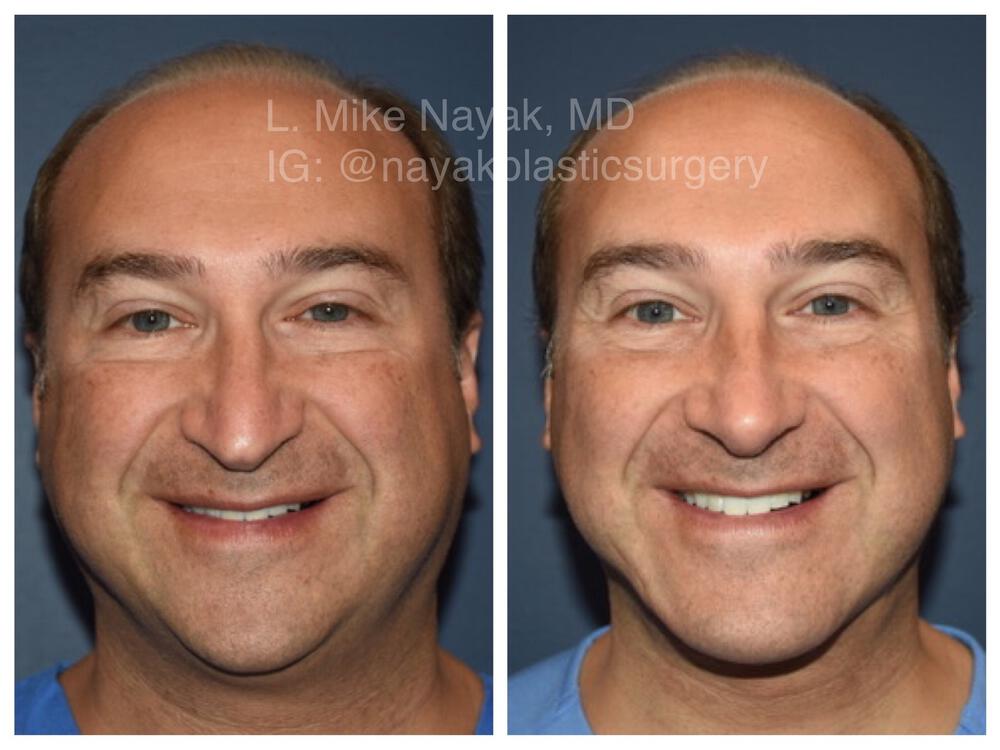 Chin Implants Before & After Image