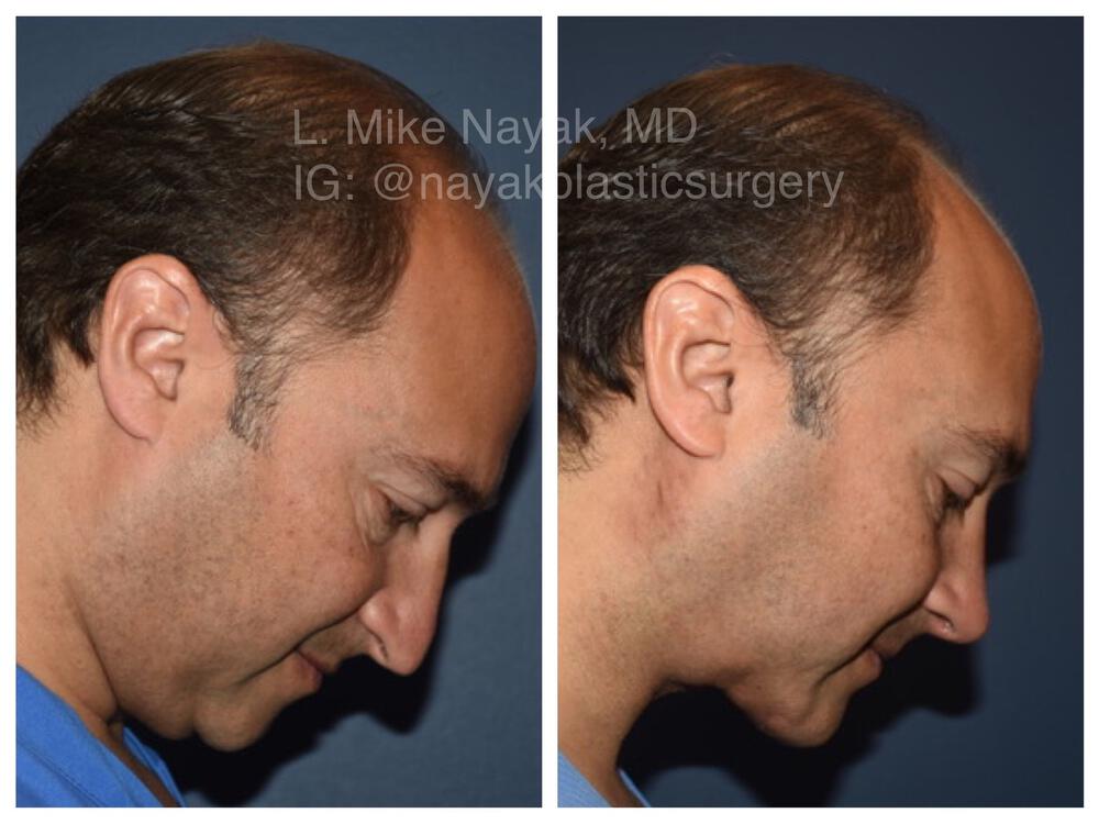 Chin Implants Before & After Image