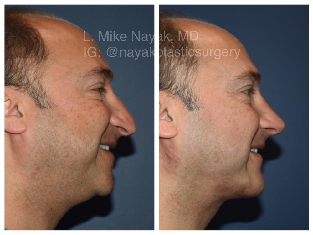 Chin Implants Before & After Image