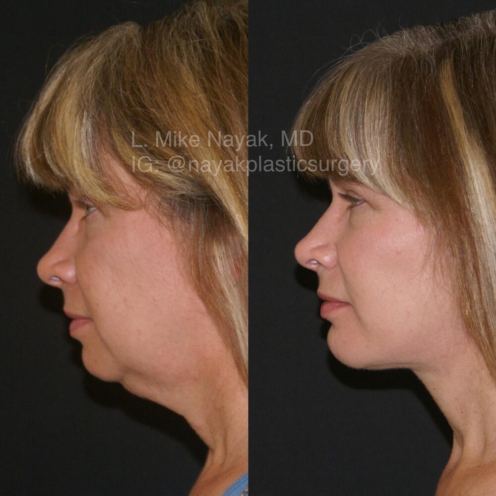 Chin Implants Before & After Image