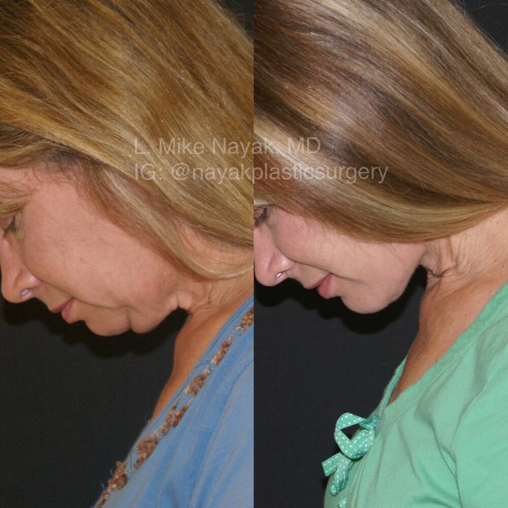 Chin Implants Before & After Image