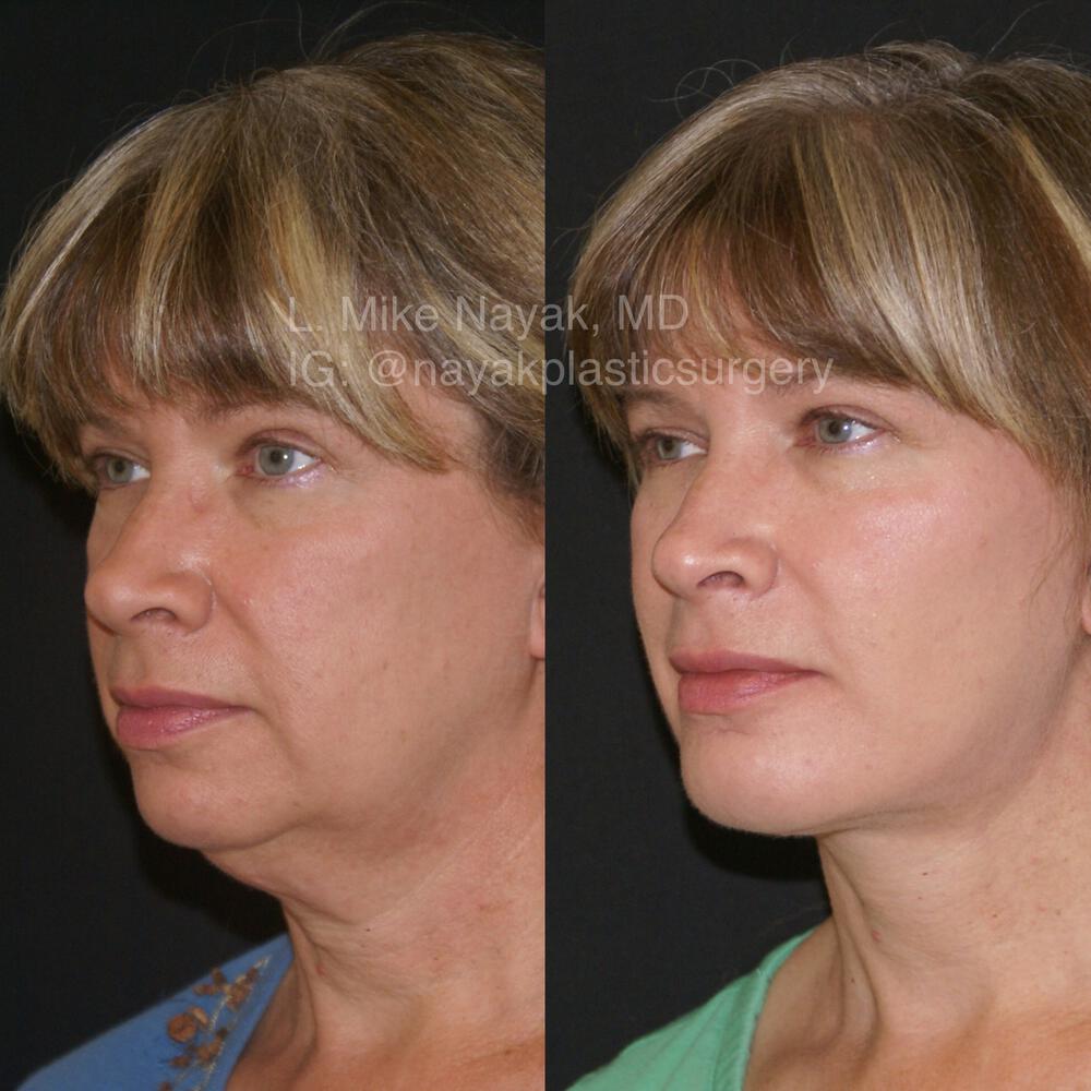 Chin Implants Before & After Image