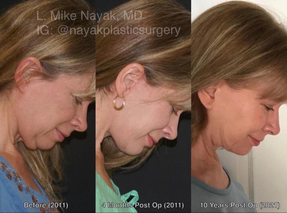 Chin Implants Before & After Image