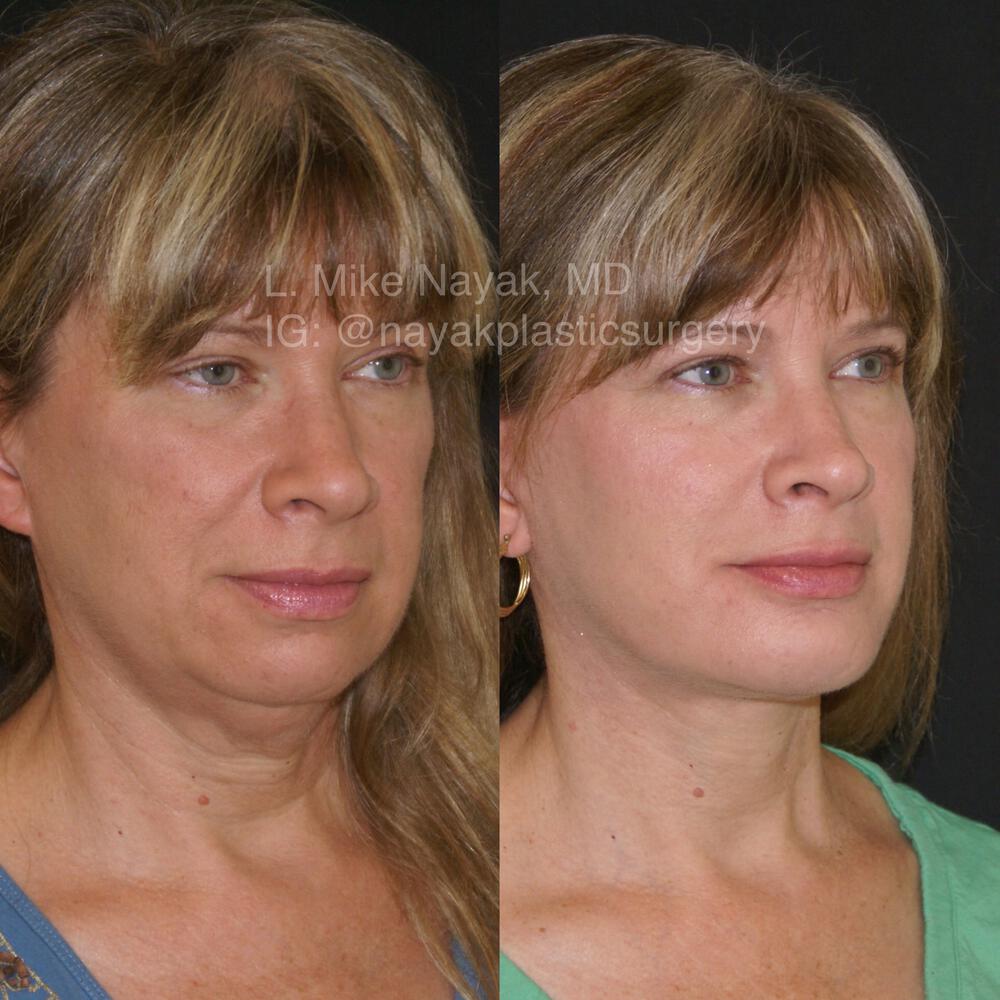 Chin Implants Before & After Image