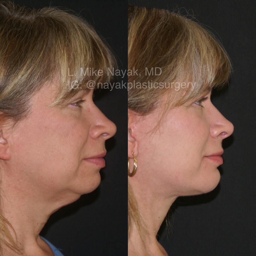 Chin Implants Before & After Image