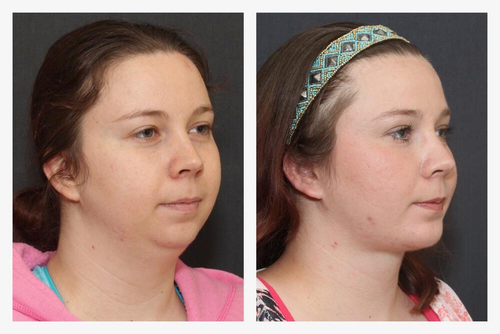 Chin Implants Before & After Image