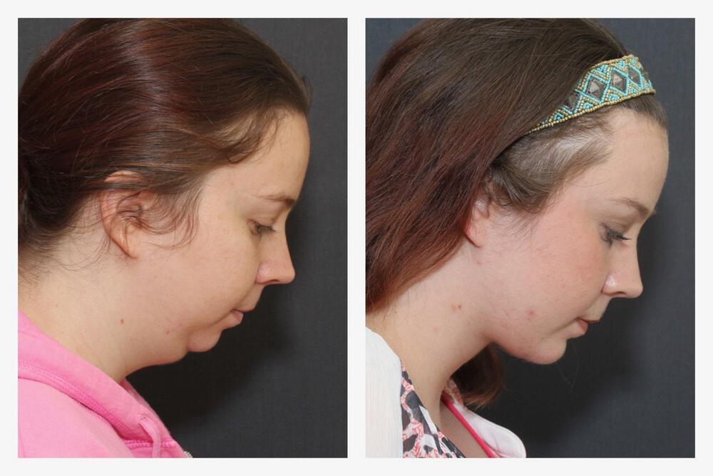 Chin Implants Before & After Image