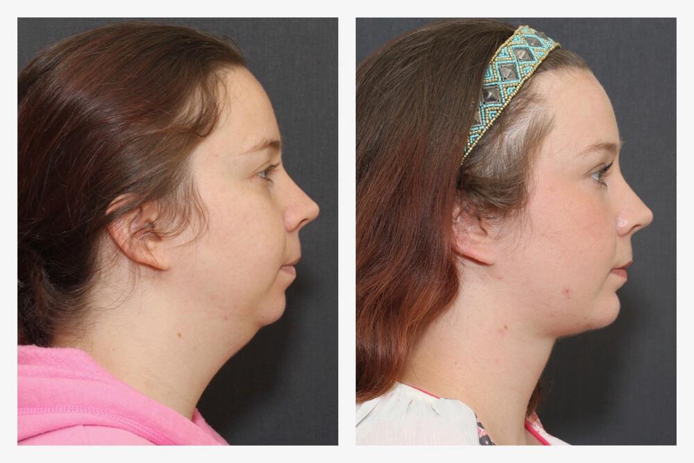 Chin Implants Before & After Image