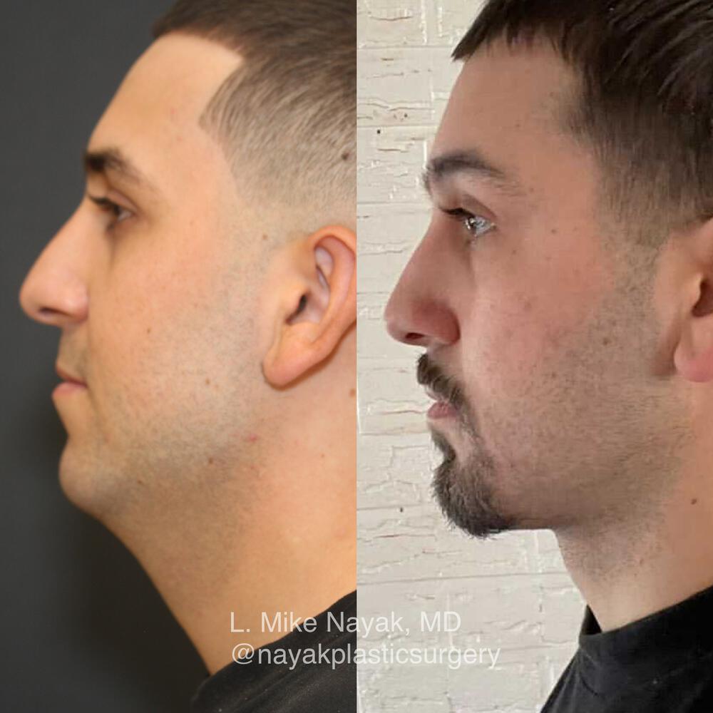 Chin Implants Before & After Image