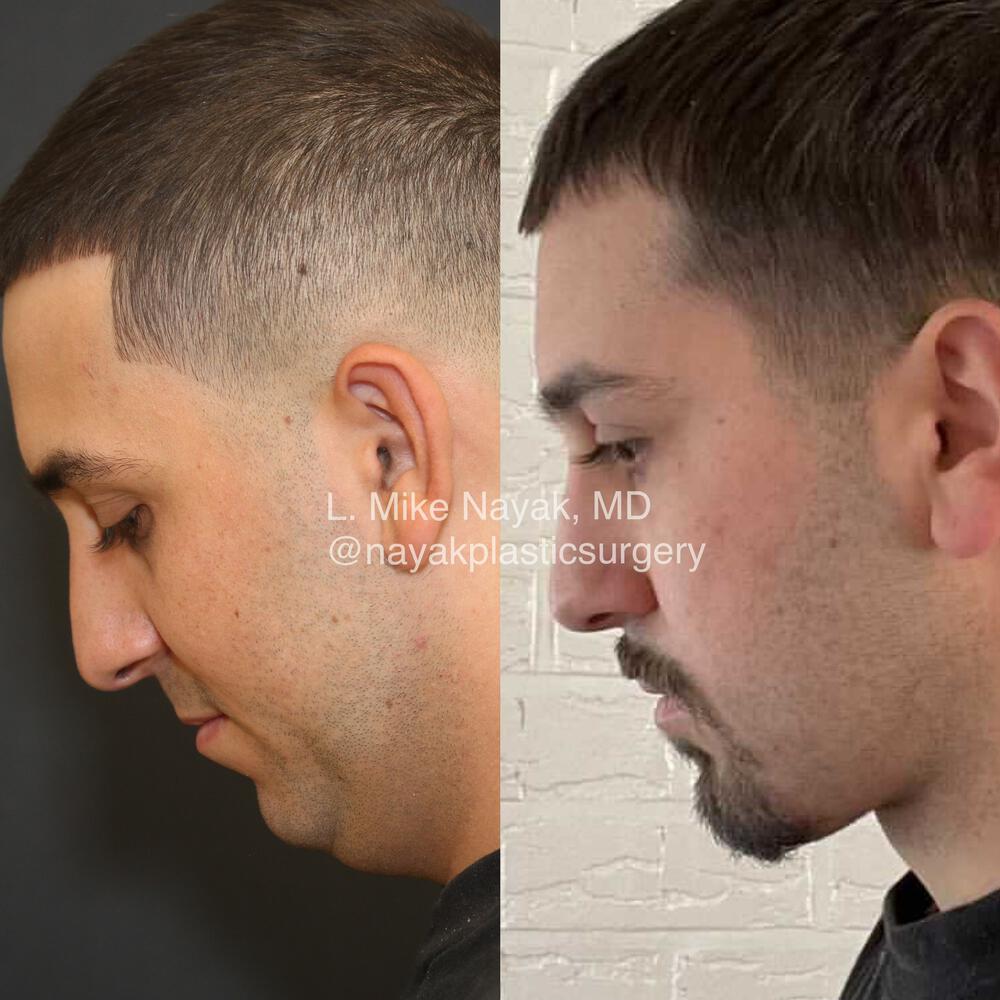 Chin Implants Before & After Image