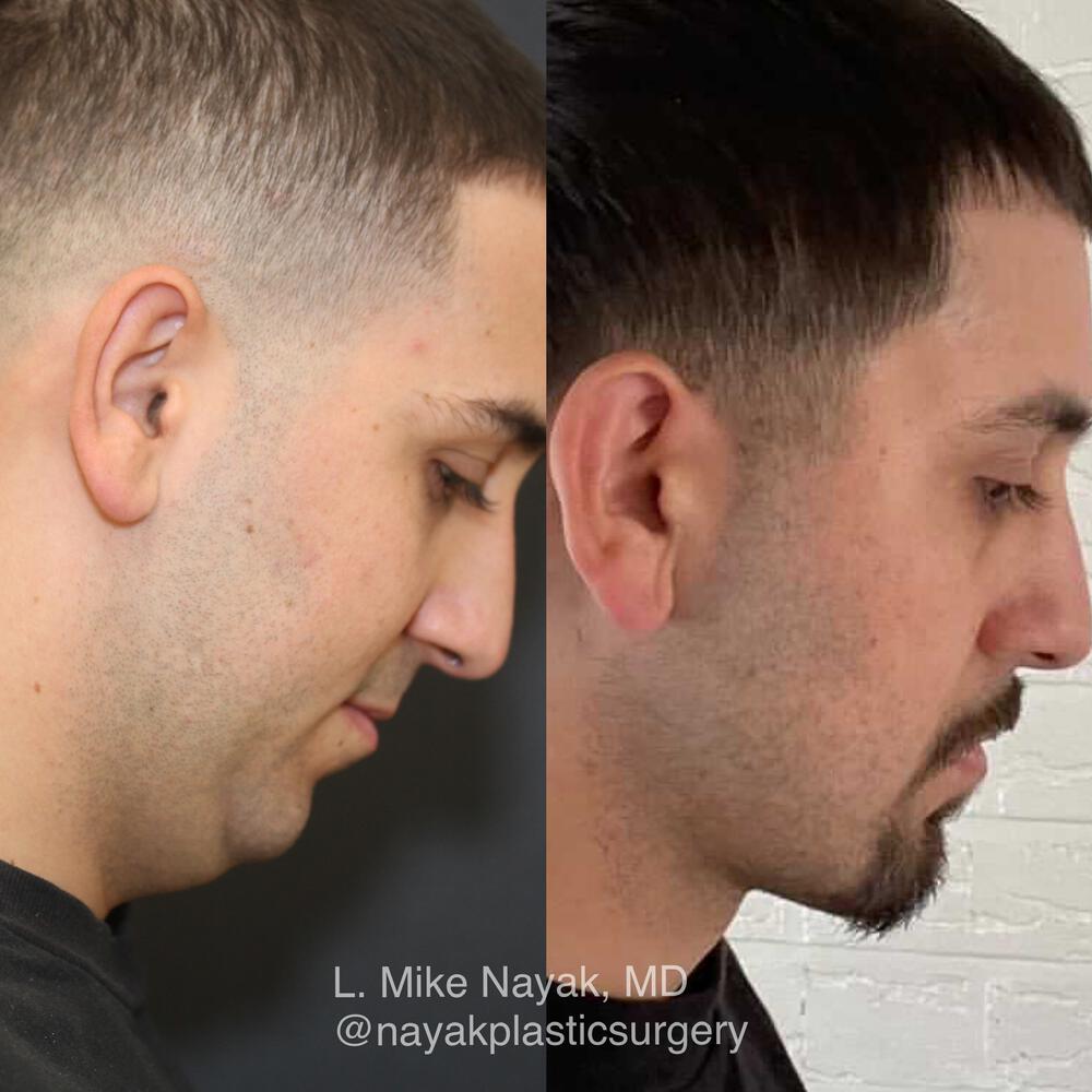 Chin Implants Before & After Image