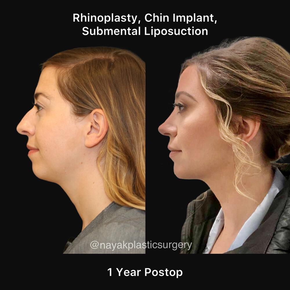 Chin Implants Before & After Image