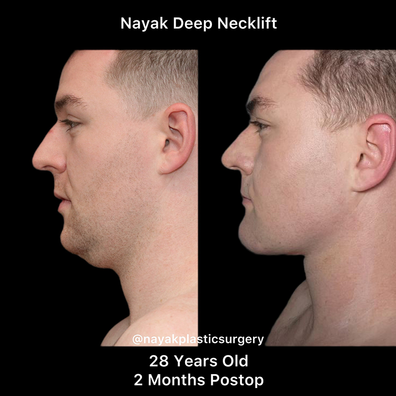 Chin Implants Before & After Image