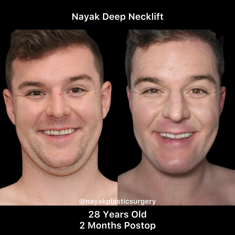 Chin Implants Before & After Image