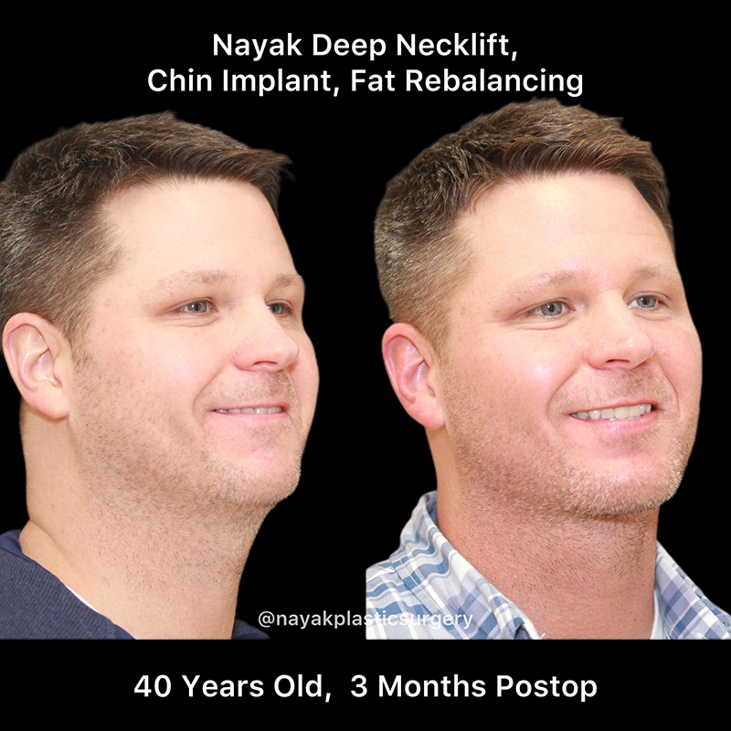 Chin Implants Before & After Image